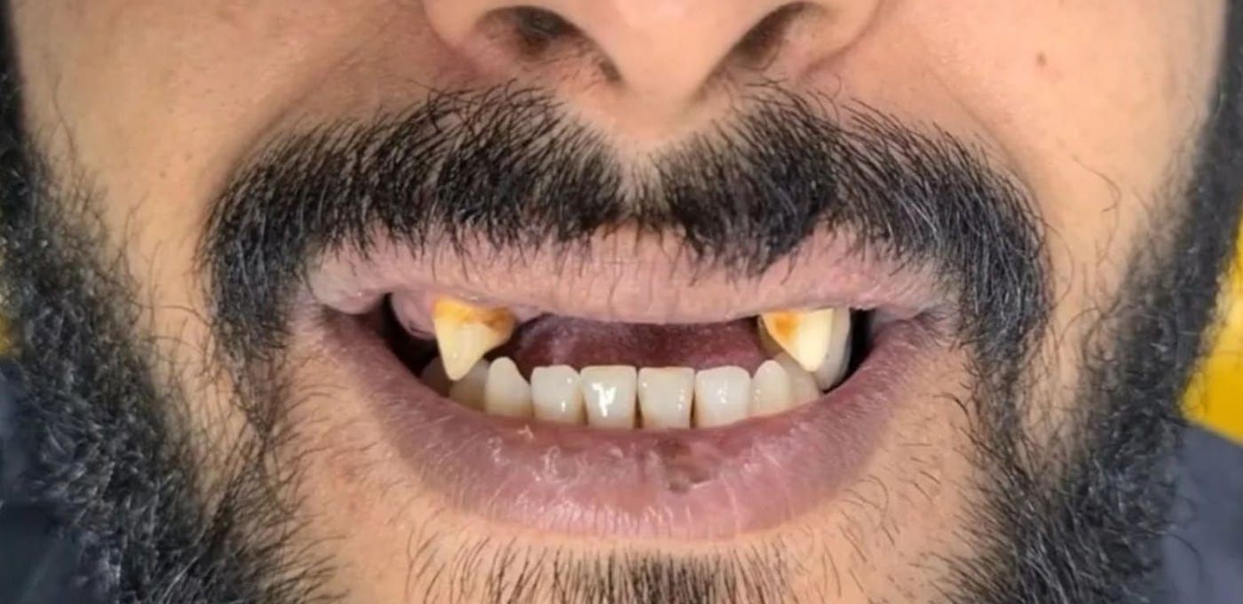 قبل العلاج